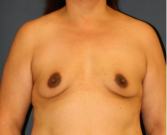 Feel Beautiful - Breast Augmentation 153 - Before Photo